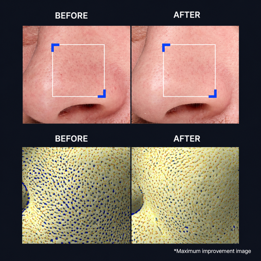 Before and after results showing smoother skin texture and refined pores with IOPE Retinol Super Bounce Serum RX